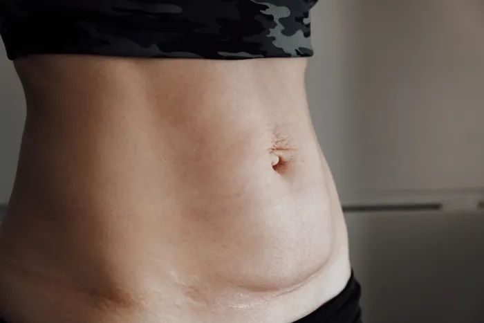 How to Reduce Tummy After C-Section?